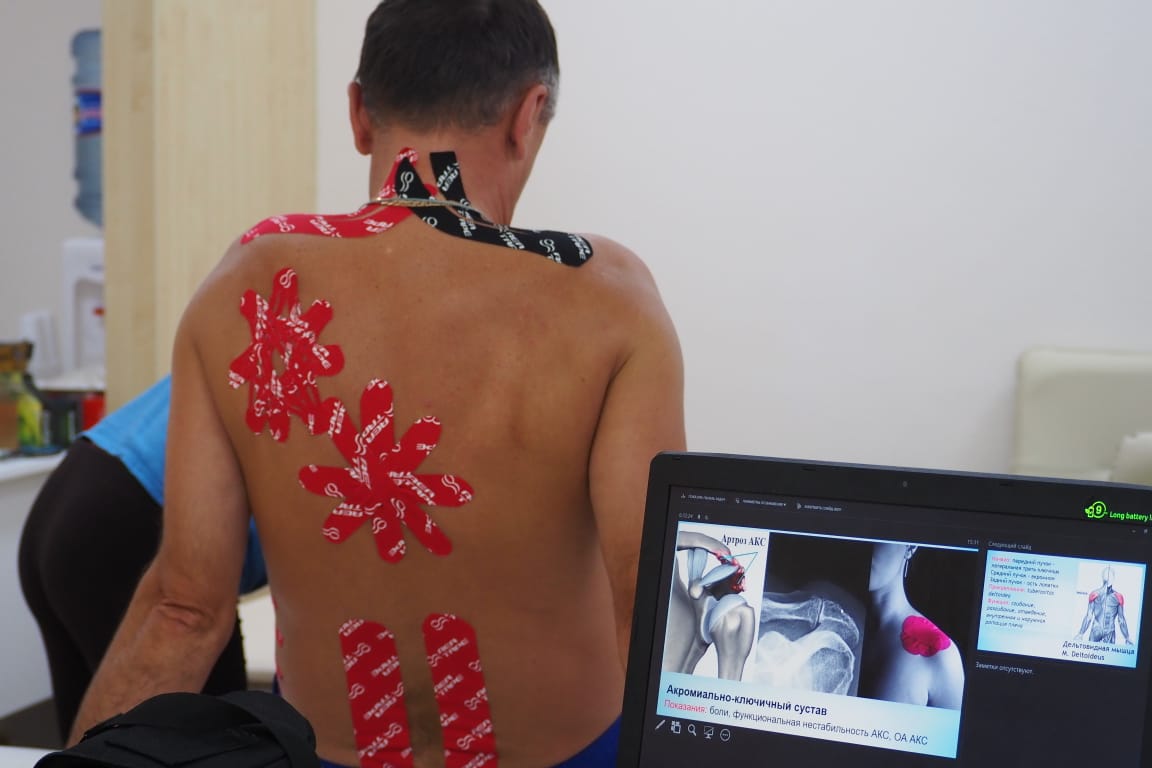 Кинезиотейпирование